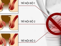 Bệnh trĩ nội độ 1 có tự khỏi được không?