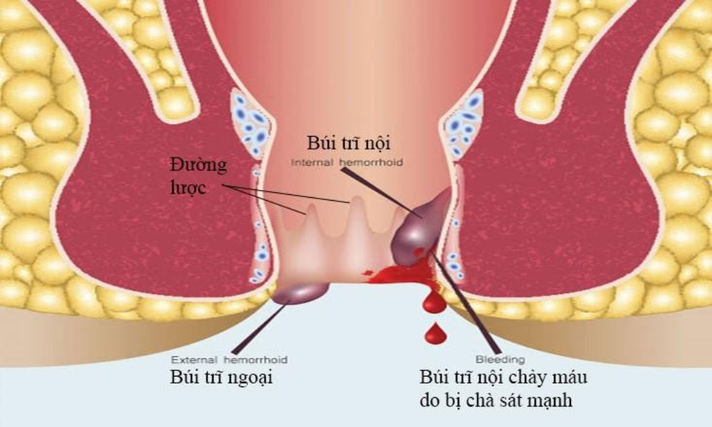 triệu chứng ở giai đoạn này khá nhẹ nên dễ khiến người bệnh nghĩ rằng bệnh sẽ tự hết theo thời gian mà không cần can thiệp gì thêm.