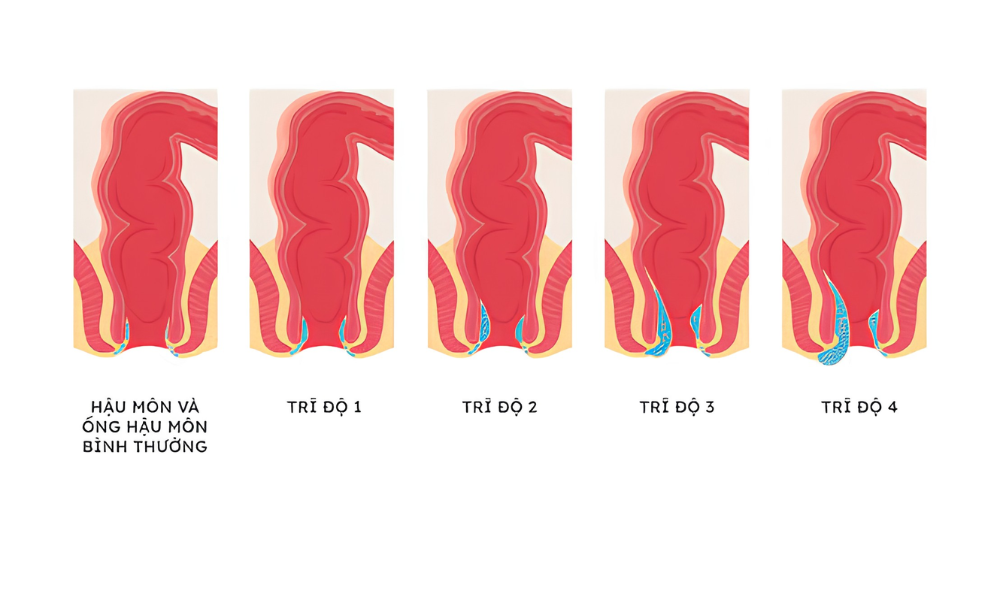 Bệnh trĩ nội độ 1 có tự khỏi được không?