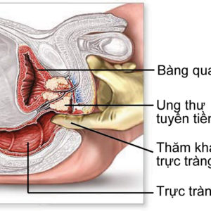 8 thực phẩm giúp ngăn ngừa ung thư tuyến tiền liệt