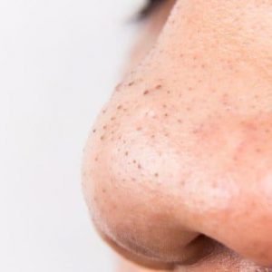 Top 4 cách trị mụn đầu đen ở mũi tận gốc tại nhà hiệu quả, bạn hãy thử ngay