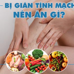 Suy giãn tĩnh mạch nên ăn gì? Top 10+ thực phẩm tốt nhất