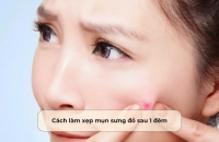 Cách làm xẹp mụn sưng đỏ sau 1 đêm
