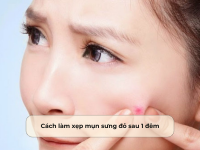 Cách làm xẹp mụn sưng đỏ sau 1 đêm