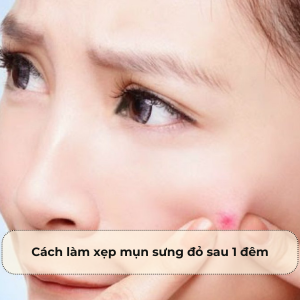 Cách làm xẹp mụn sưng đỏ sau 1 đêm: Bí quyết từ chuyên gia chăm sóc da