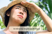 Da mặt bị cháy nắng làm sao để trắng lại