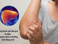 Uống thuốc giải độc gan bị ngứa – Nguyên nhân và hướng xử lý đúng cách